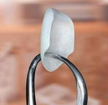 An ultrathin porcelain veneer (like one of a set of Lumineers) being held by a tool to show how thin it is.