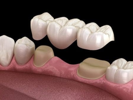 A diagram of a ceramic bridge that a metal-free dentist would use. The bridge is composed of two ceramic crowns supporting a natural-looking ceramic tooth between them.