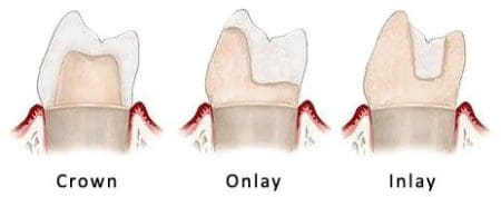 A diagram showing the difference between porcelain crowns, which cover the whole tooth, porcelain onlays, which cover at least one cusp of the tooth, and inlays, which fill in between the two preserved cusps.