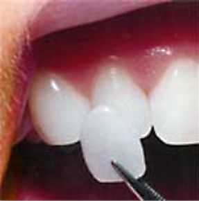 porcleain veneer being held up to a tooth